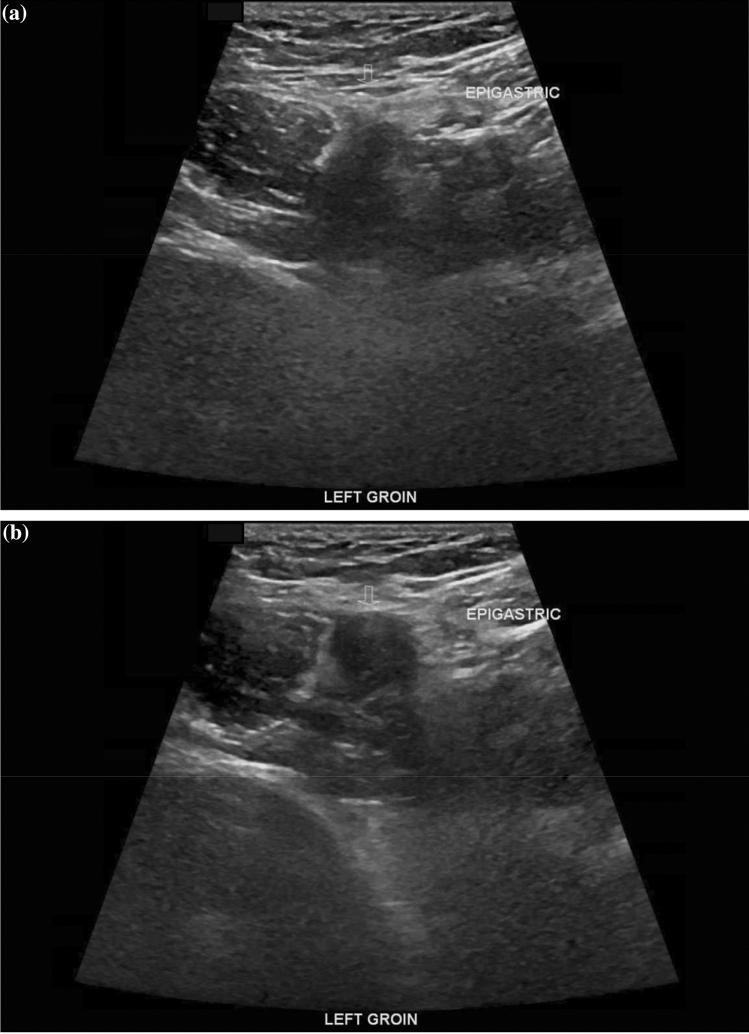 Ultrassom da virilha esquerda antes e durante a manobra de Valsalva mostrando protrusão de partes moles no canal inguinal, medial aos vasos epigástricos inferiores