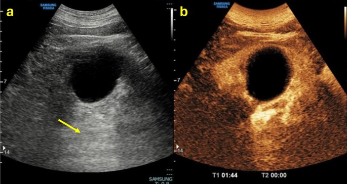 Ultrassom do rim mostrando cisto cortical anecoico com reforço acústico posterior e, ao lado, ultrassom com contraste sem realce da lesão, cisto simples Bosniak I