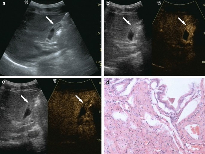 Ultrassom da vesícula biliar mostrando lesão polipoide isoecoica presa à parede, imagens de ultrassom com contraste e lâmina de patologia de pólipo de colesterol