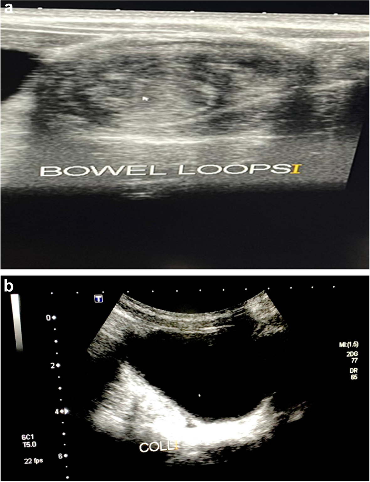 Ultrassom transversal do abdome de criança mostrando imagem arredondada com anéis concêntricos claros e escuros, o sinal do alvo da invaginação intestinal, e líquido livre ao lado