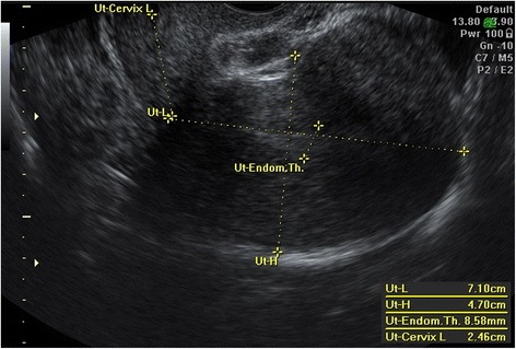 Ultrassonografia transvaginal em corte sagital do útero com calipers medindo comprimento e altura uterinos, colo e espessura endometrial em dupla camada (8,58 mm)