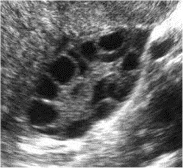 Ultrassom transvaginal 2D de ovário com vários folículos antrais anecoicos arredondados distribuídos no estroma
