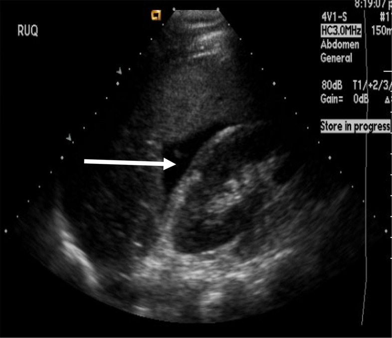 Ultrassom FAST do quadrante superior direito com faixa anecoica entre o fígado e o rim direito (seta), correspondente a hemoperitônio no espaço de Morison