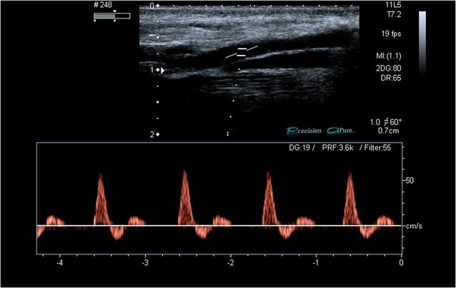 Doppler espectral de artéria de membro inferior com onda multifásica de alta resistência: pico sistólico estreito, refluxo protodiastólico abaixo da linha de base e pequeno componente anterógrado no fim da diástole