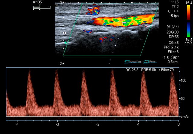 Doppler colorido e espectral de artéria de membro inferior com onda monofásica de baixa resistência: fluxo diastólico anterógrado contínuo acima da linha de base, sem refluxo