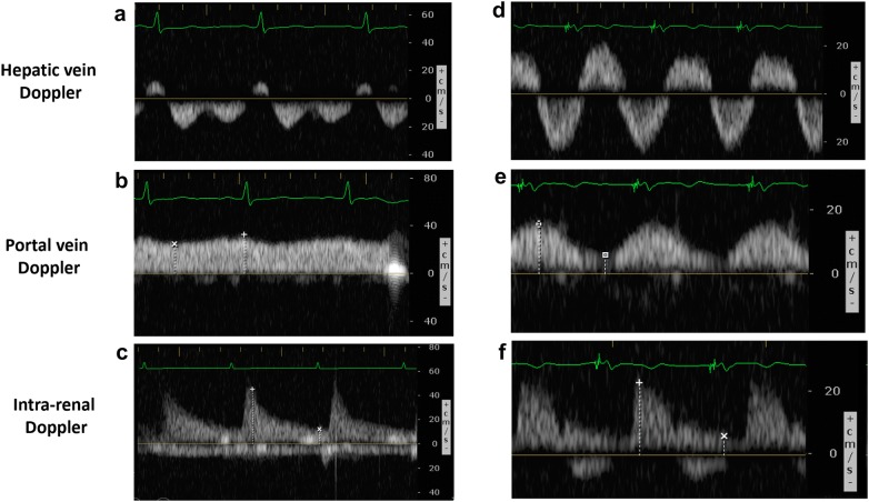 Doppler das veias hepática, porta e intrarrenal em dois pacientes: à esquerda padrões normais (VExUS grau 1) e à direita reversão sistólica hepática, porta muito pulsátil e fluxo intrarrenal só diastólico (VExUS grau 3)