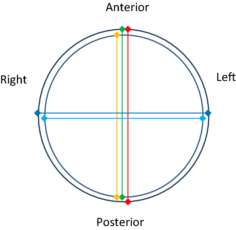 Esquema de corte transversal de aneurisma de aorta abdominal mostrando a posição dos calipers nos métodos interna a interna, borda de ataque e externa a externa, nos eixos anteroposterior e transverso