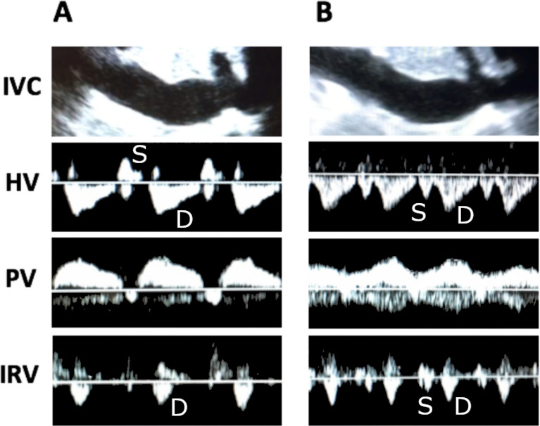 Veia cava inferior e Doppler das veias hepática, porta e intrarrenal antes (A) e depois (B) de ultrafiltração, com melhora dos padrões de congestão