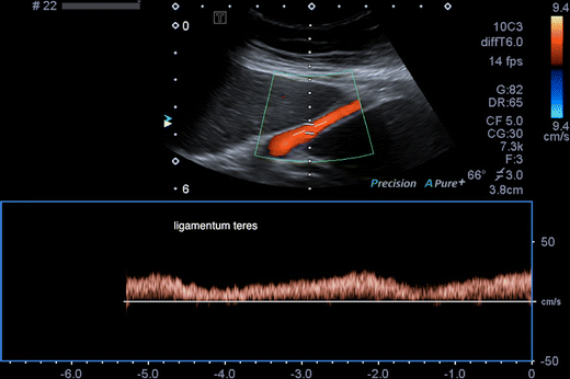 Doppler colorido e espectral mostrando fluxo venoso no ligamento redondo, correspondente à veia paraumbilical recanalizada na hipertensão portal