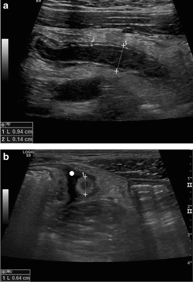 Ultrassom de apendicite aguda em cortes longitudinal e transversal: apêndice com diâmetro acima de 6 mm, parede espessada, sinal do alvo e líquido ao redor