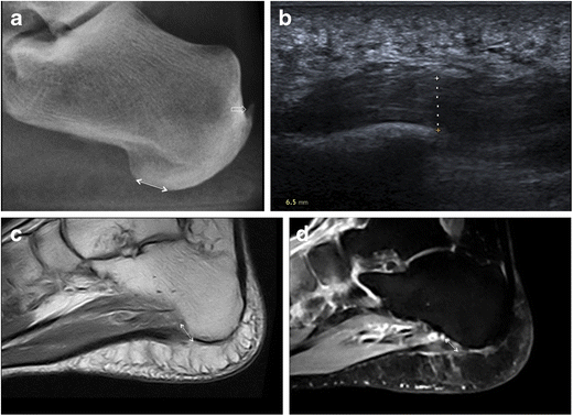 Fascite plantar: radiografia, ultrassom com fáscia plantar espessada de 6,5 mm e ressonância do calcanhar