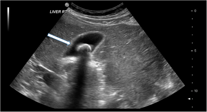Ultrassom da vesícula biliar em corte sagital mostrando cálculo hiperecoico com sombra acústica posterior, uma faixa escura atrás da pedra