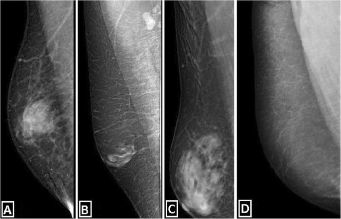 Mamografias em incidência oblíqua mostrando ginecomastia nodular, dendrítica e glandular difusa e pseudoginecomastia