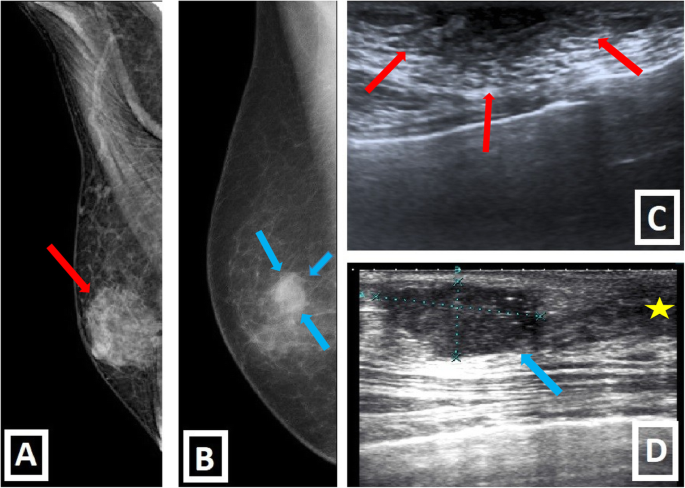 Mamografia e ultrassom comparando ginecomastia nodular retroareolar bilateral com carcinoma ductal invasivo excêntrico unilateral na mama masculina