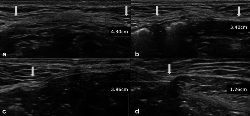 Quatro cortes transversais de ultrassom da parede abdominal com caliper entre as bordas mediais dos músculos retos, medindo 4,30 cm acima do umbigo, 3,40 cm abaixo do umbigo e 3,86 cm mais 1,26 cm na altura do umbigo