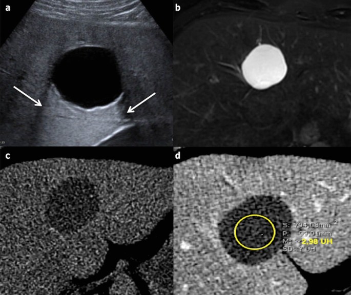 Cisto simples no fígado: no ultrassom, imagem redonda, preta (anecoica), de contornos nítidos e com reforço acústico posterior, ao lado das imagens de ressonância e tomografia do mesmo cisto