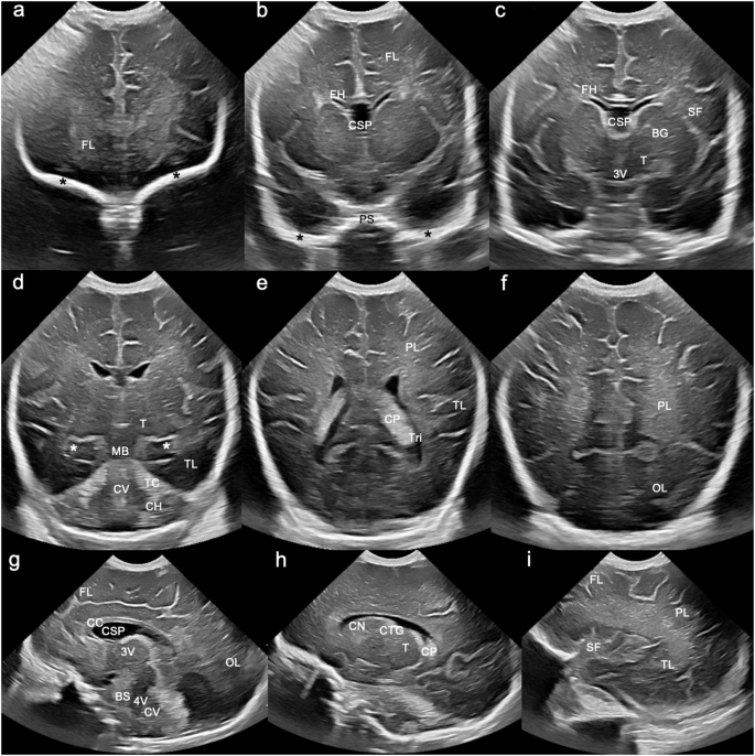 Painel de imagens de ultrassom transfontanelar de recém-nascido mostrando seis cortes coronais e cortes sagitais pela fontanela anterior, com lobos frontais, ventrículos laterais, tálamos e cerebelo identificados