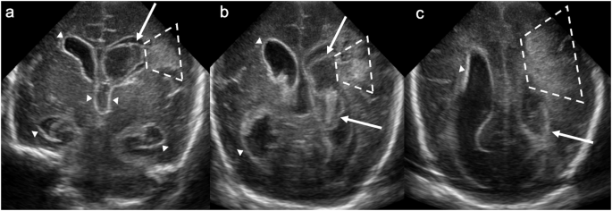 Ultrassom transfontanelar em cortes coronais de prematuro mostrando área em leque de aumento de ecogenicidade na substância branca periventricular esquerda e coágulo dentro do ventrículo lateral esquerdo