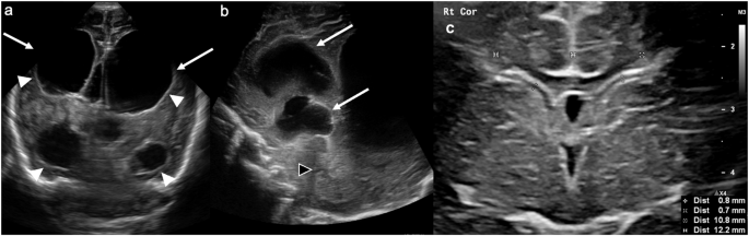 Ultrassom transfontanelar de prematuro com ventrículos laterais e terceiro ventrículo dilatados e, em corte coronal no nível dos forames de Monro, as medidas da largura do corno anterior e do índice ventricular