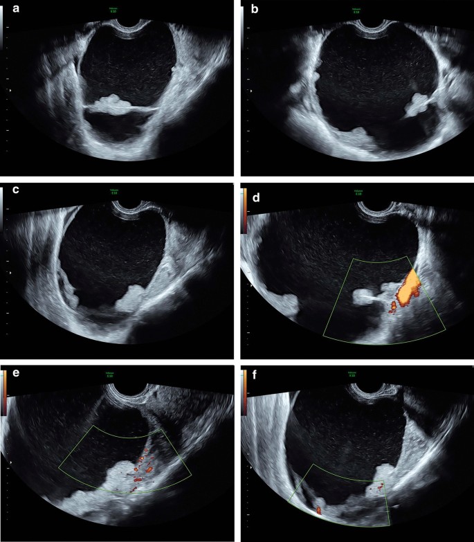 Ultrassom transvaginal em escala de cinza e Doppler colorido de massa multilocular-sólida do ovário direito com projeções papilares, tumor borderline seroso