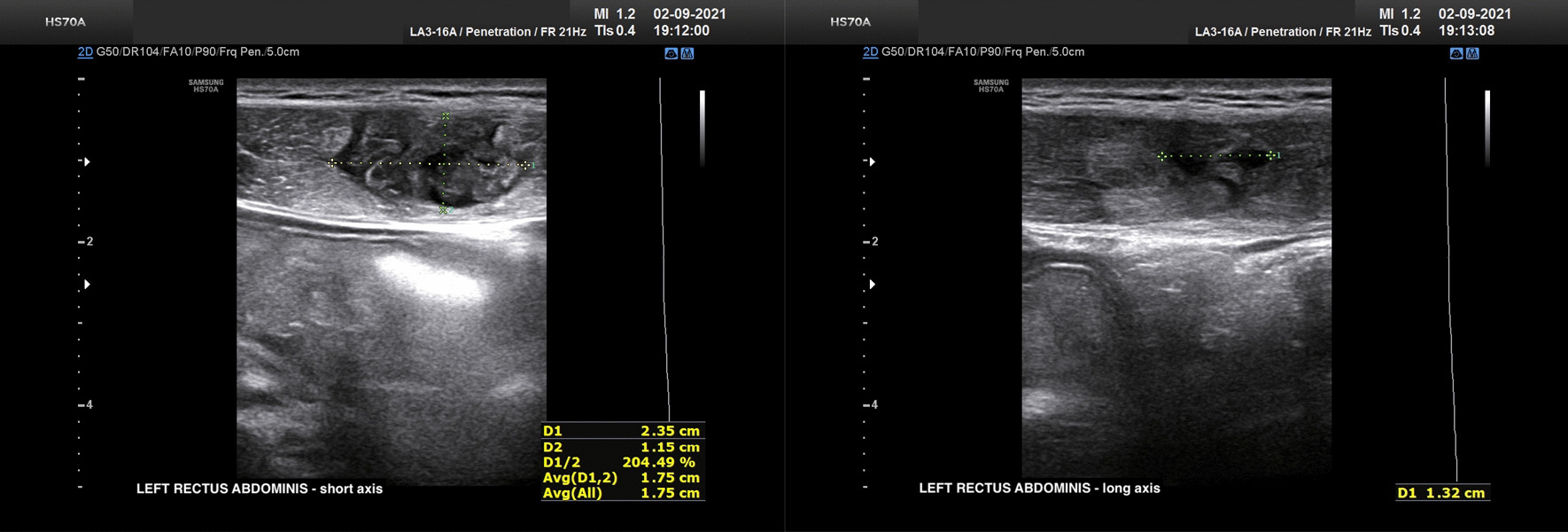 Ultrassom de lesão do reto abdominal esquerdo: no eixo curto, área hipo-anecoica irregular medida em 2,35 cm transversal e 1,15 cm anteroposterior; no eixo longo, medida longitudinal da lesão