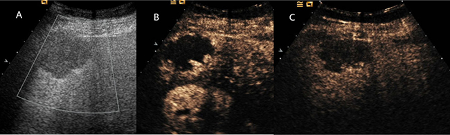 Hemangioma hepático: nódulo hipoecoico subcapsular no modo B e, no ultrassom com contraste, realce periférico nodular e descontínuo