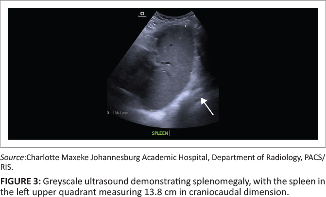 Ultrassom em escala de cinza do hipocôndrio esquerdo mostrando baço aumentado, com maior eixo craniocaudal de 13,8 cm