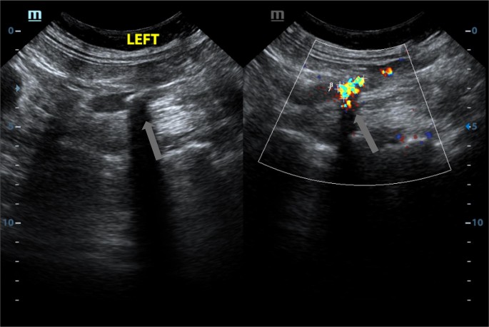 Ultrassom de cálculo no ureter superior: à esquerda em modo B, imagem ecogênica mal delimitada; à direita, Doppler colorido com artefato de cintilação cobrindo o cálculo