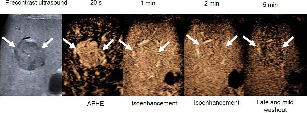 Nódulo de 34 mm em fígado cirrótico no ultrassom com contraste, com hiper-realce arterial e lavagem tardia e discreta aos 5 minutos, categoria CEUS LR-5