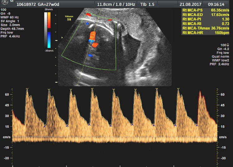 Doppler da artéria cerebral média fetal com 27 semanas: corte axial do crânio com Doppler colorido do vaso, volume de amostra alinhado com ângulo de 1 grau e onda espectral com pico de velocidade sistólica de 65,35 cm/s