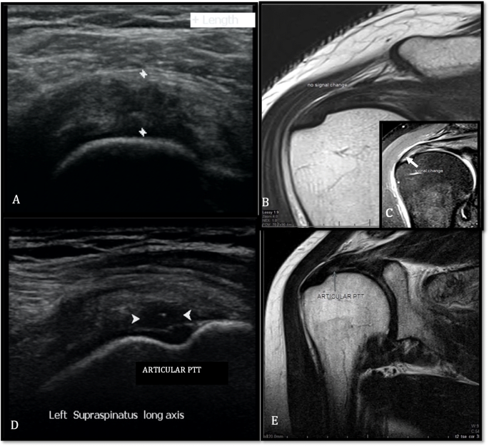Ultrassom do supraespinal comparando tendinose, com tendão espessado e heterogêneo, e ruptura parcial da face articular, com área anecoica, e imagens de ressonância correspondentes