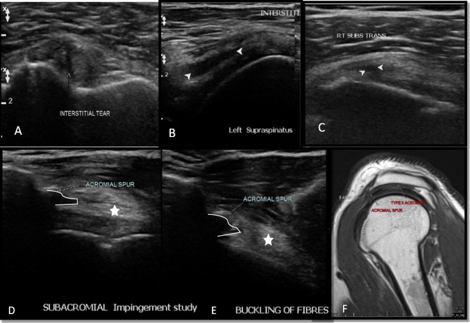 Ultrassom mostrando rupturas intrassubstanciais do bíceps, supraespinal e subescapular e, em abdução, esporão acromial impedindo o deslizamento do supraespinal, com ressonância correspondente