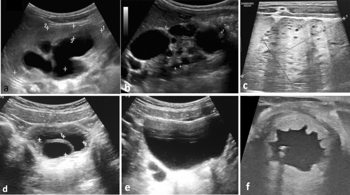 Painel de imagens de ultrassom pediátrico mostrando rim com dilatação da pelve e dos cálices, rim multicístico, rim policístico, ureterocele, ureter duplo e bexiga espessada por válvula de uretra posterior