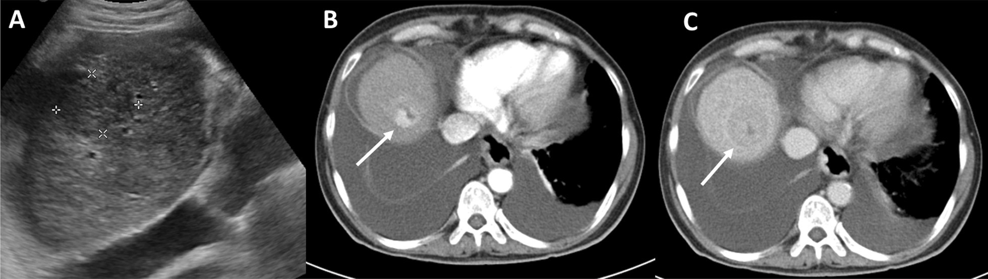 Ultrassom de fígado cirrótico com nódulo hipoecoico de 2,5 cm no lobo direito e tomografia com realce arterial e lavagem na fase portal, compatível com carcinoma hepatocelular
