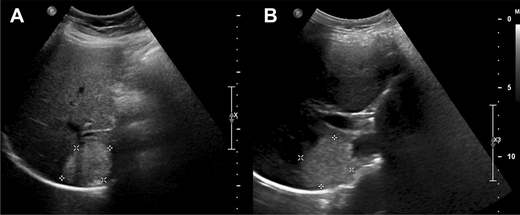 Ultrassom de fígado cirrótico com nódulo hiperecoico de 4 cm no exame inicial e no controle de 2 anos, sem mudança, compatível com hemangioma