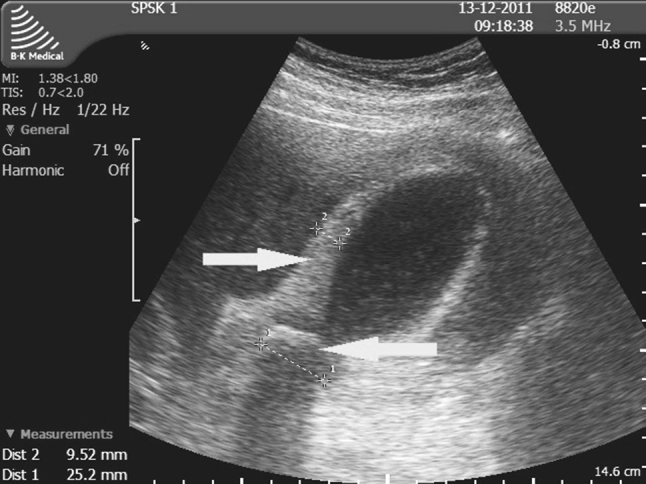 Ultrassom de vesícula biliar com colecistite aguda: parede espessada medida em 9,5 mm e grande cálculo de 25 mm obstruindo o colo da vesícula, indicados por setas