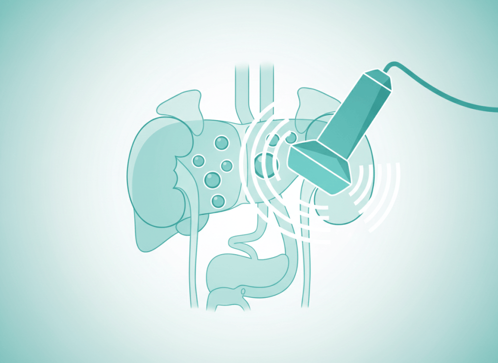 Ilustração em tons de verde-azulado de órgãos do abdome com transdutor de ultrassom e pequenos cistos destacados, representando achados incidentais