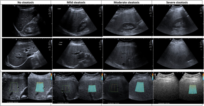 Painel de ultrassom do fígado sem esteatose, com esteatose leve, moderada e acentuada, com contraste fígado-rim, borramento vascular e medidas de coeficiente de atenuação