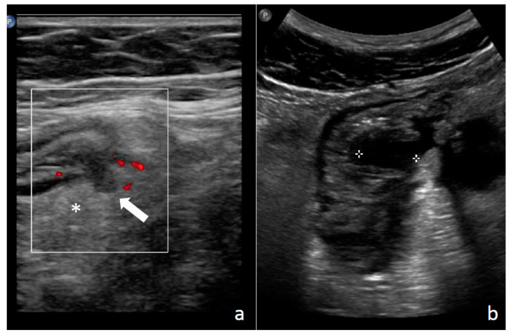 Ultrassom de diverticulite aguda: divertículo projetando-se da parede do cólon descendente, envolto por gordura ecogênica não compressível com hipervascularização discreta ao power Doppler, e abscesso hipoecoico na parede cólica espessada