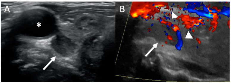 Ultrassom de adenoma de paratireoide: corte transversal com lesão ovoide hipoecoica posterior ao lobo direito da tireoide e à carótida, e Doppler colorido com vaso nutridor polar e vascularização periférica