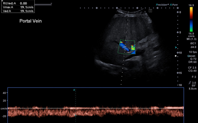 Doppler colorido e espectral da veia porta com fluxo hepatofugal: vaso em azul e traçado espectral contínuo abaixo da linha de base, velocidade máxima de 19,1 cm/s