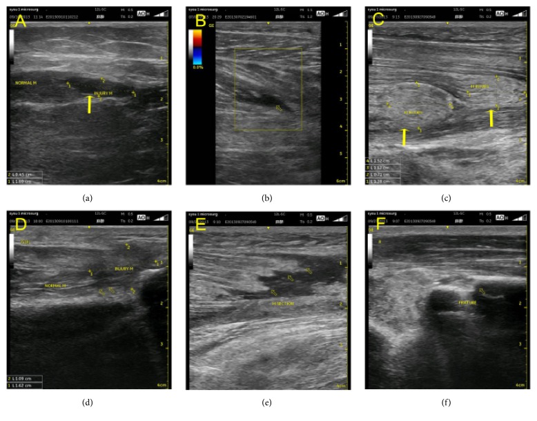 Cortes longitudinais de ultrassom de músculo com rotura grau I e grau II, área hipoecoica entre as fibras, e grau III com rotura extensa, retração e fragmentos musculares flutuando em líquido, além de fratura do rádio