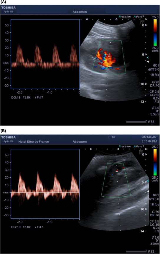 Doppler espectral de artérias intrarrenais em dois rins transplantados com hematoma subcapsular: fluxo de alta resistência sem componente diastólico e com refluxo diastólico, índice de resistividade igual a 1
