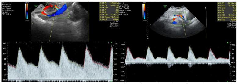Doppler espectral da artéria uterina com 23 a 24 semanas: à esquerda, gestação normal com fluxo diastólico alto; à direita, gestação que evoluiu com pré-eclâmpsia precoce, com diástole mais baixa e IP e IR aumentados