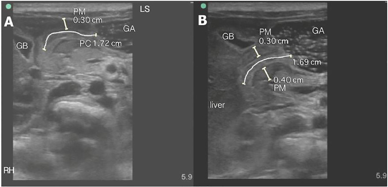 Ultrassom de lactente em corte longitudinal do piloro mostrando canal pilórico alongado e musculatura espessada, com medidas do comprimento do canal e da espessura muscular