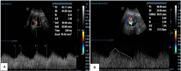 Doppler espectral da artéria renal principal e de artéria intrarrenal com onda tardus parvus: ascensão sistólica lenta, pico arredondado e baixa amplitude, tempo de aceleração de 240 ms e índice de resistividade baixo