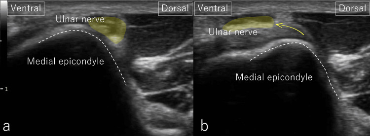 Dois cortes axiais de ultrassom do cotovelo: com 60 graus de flexão o nervo ulnar fica posterior ao epicôndilo medial; com 90 graus o nervo se desloca anteriormente sobre o epicôndilo