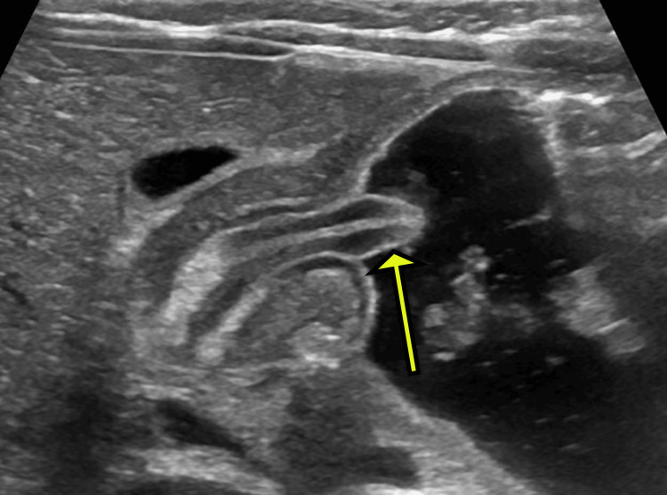 Ultrassom longitudinal do antro distendido por líquido com a mucosa pilórica redundante fazendo saliência no antro, sinal do mamilo antral, indicada por seta amarela