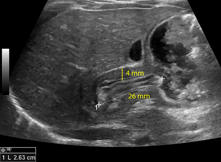 Ultrassom longitudinal da região antropilórica de lactente com estenose hipertrófica do piloro, canal pilórico alongado medindo 26 mm e parede muscular hipoecoica de 4 mm