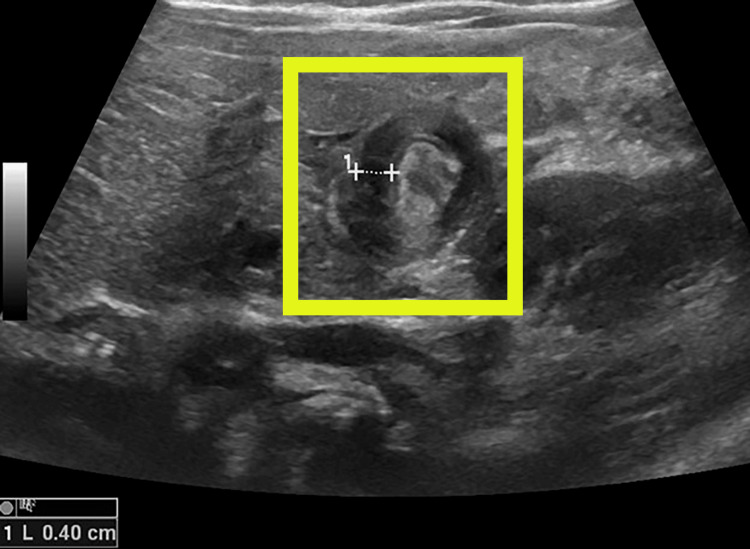 Ultrassom transversal do piloro de lactente mostrando parede muscular hipoecoica espessada ao redor da mucosa central ecogênica, aspecto em rosquinha, com medida da espessura muscular